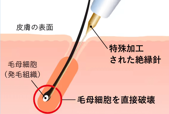 ニードル脱毛の仕組みをあらわした画像