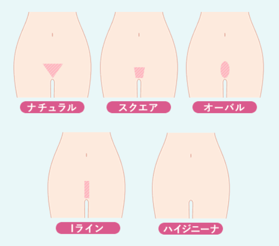 VIO脱毛のデザイン・形・ハイジニーナの画像